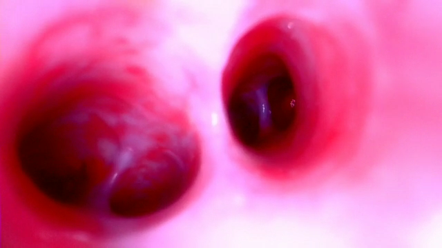 Simulated Bronchoscopy Model